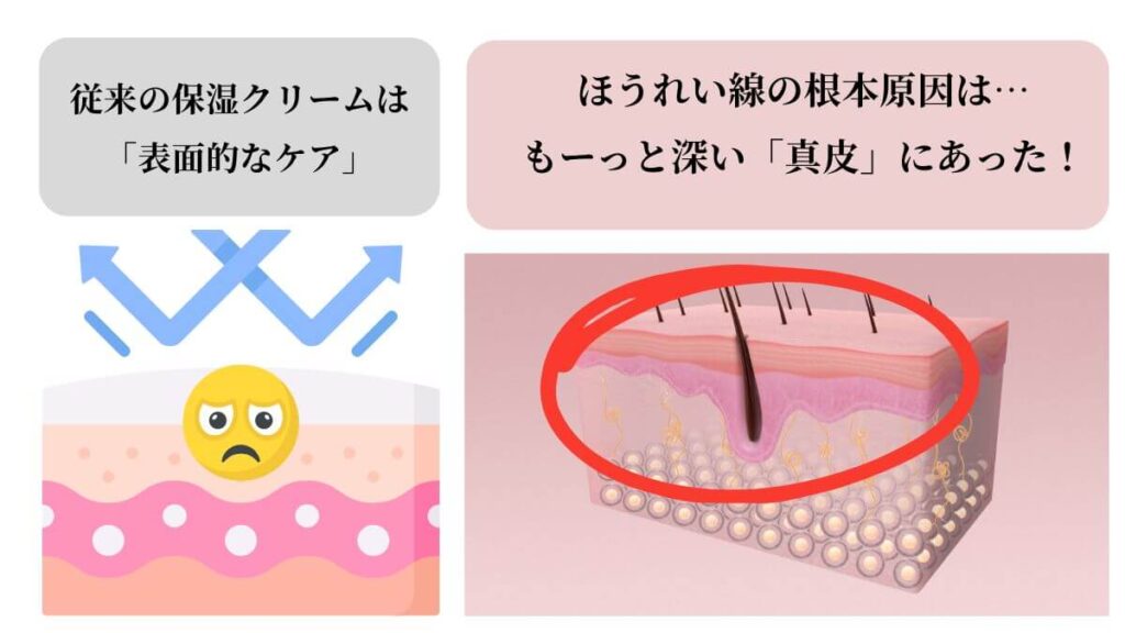 40代のほうれい線の原因を解説する肌の断面図。自宅ケアでは届きにくい、肌の奥深くに原因があることを示している。