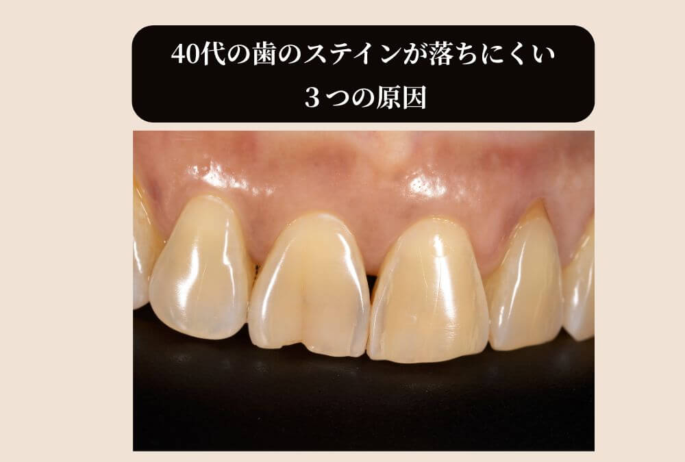 40代の歯にステインが付いた画像。落ちにくい原因を考える。
